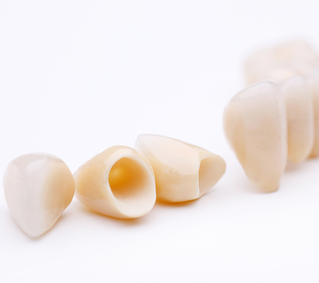 Temecula Dental Crowns and Dental Bridges