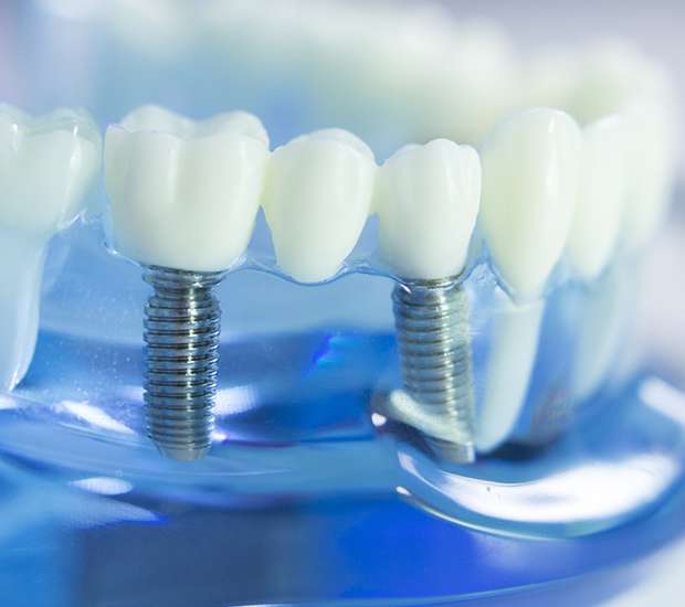 Temecula Dental Implants